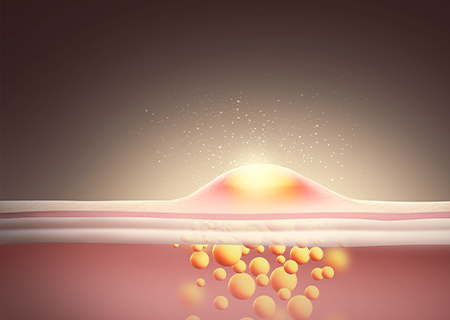 여드름/모공흉터