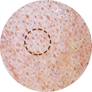 아이스픽형 여드름